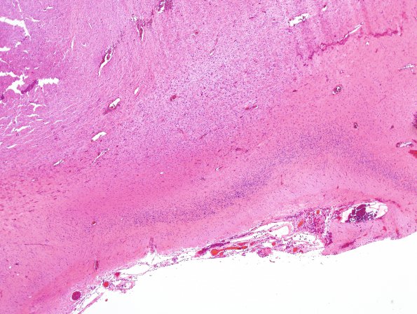 1B2 Astrocytoma, pilocytic (Case 1) H&E 5