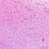 1B3 Astrocytoma, pilocytic (Case 1) H&E 6