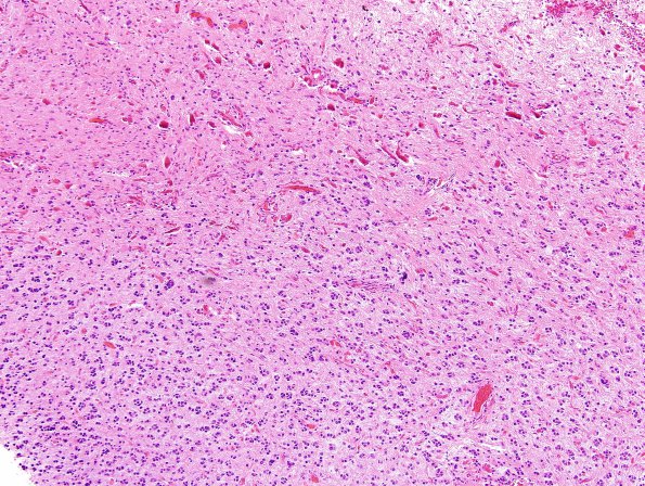 1B3 Astrocytoma, pilocytic (Case 1) H&E 6