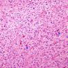 1B4 Astrocytoma, pilocytic (Case 1) H&E 3 copy