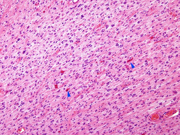 1B4 Astrocytoma, pilocytic (Case 1) H&E 3 copy