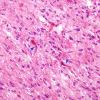 1B5 Astrocytoma, pilocytic (Case 1) H&E 2 copy