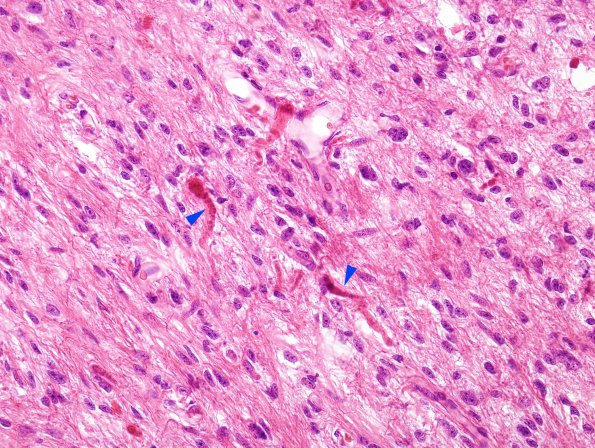 1B5 Astrocytoma, pilocytic (Case 1) H&E 2 copy