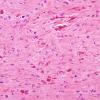 1B6 Astrocytoma, pilocytic (Case 1) H&E 1