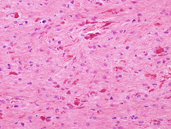 1B6 Astrocytoma, pilocytic (Case 1) H&E 1