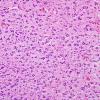 1B7 Astrocytoma, pilocytic (Case 1) H&E 9