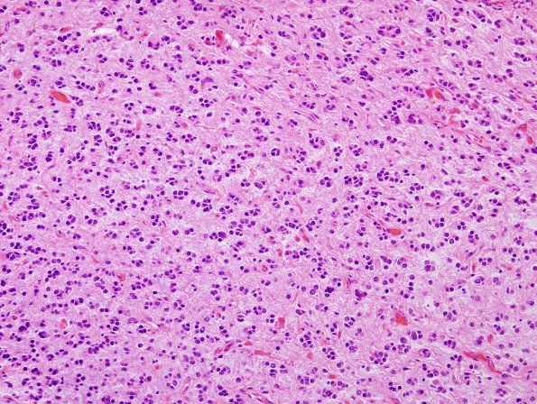 1B7 Astrocytoma, pilocytic (Case 1) H&E 9