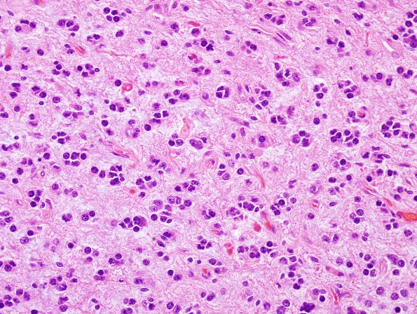 1B8 Astrocytoma, pilocytic (Case 1) H&E 8