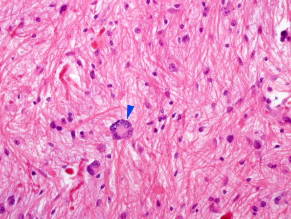 1B9 Astrocytoma, pilocytic (Case 1) H&E 7 copy