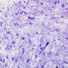 1C1 Astrocytoma, pilocytic (Case 1) Plastic 6