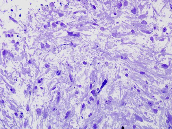 1C1 Astrocytoma, pilocytic (Case 1) Plastic 6