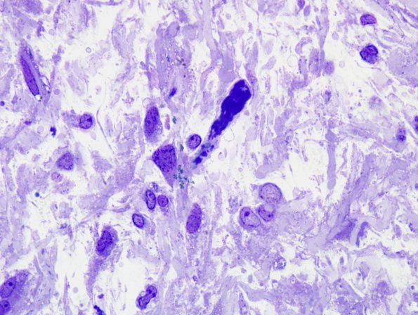 1C2 Astrocytoma, pilocytic (Case 1) Plastic 5