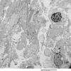 1C3 Astrocytoma, pilocytic (Case 1) 16 - Copy - Copy