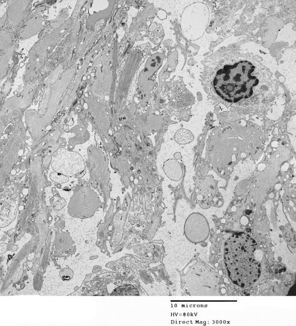 1C3 Astrocytoma, pilocytic (Case 1) 16 - Copy - Copy