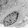 1C4 Astrocytoma, pilocytic (Case 1) 13 - Copy - Copy