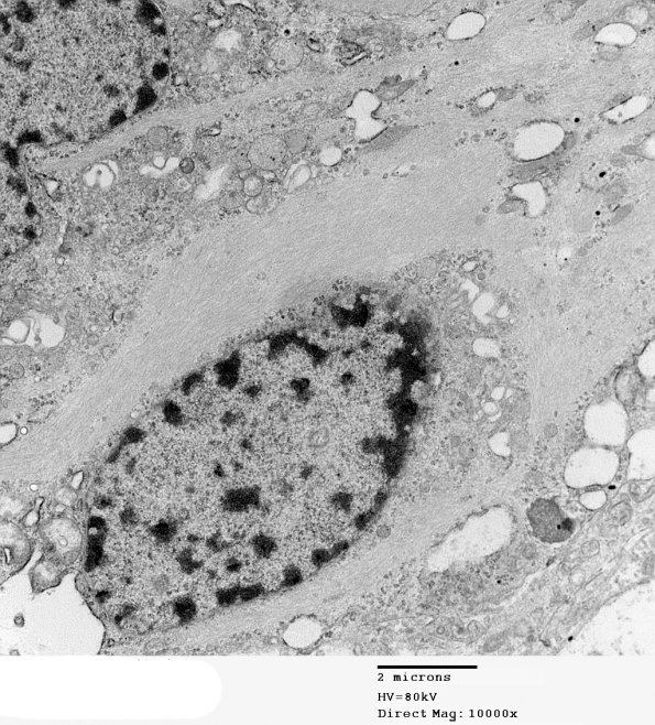 1C4 Astrocytoma, pilocytic (Case 1) 13 - Copy - Copy