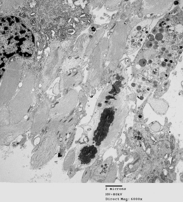 1C5 Astrocytoma, pilocytic (Case 1) 33 - Copy - Copy