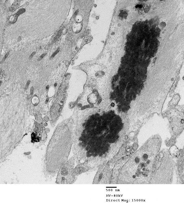 1C6 Astrocytoma, pilocytic (Case 1) 35 - Copy - Copy