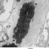 1C7 Astrocytoma, pilocytic (Case 1) 36 - Copy - Copy