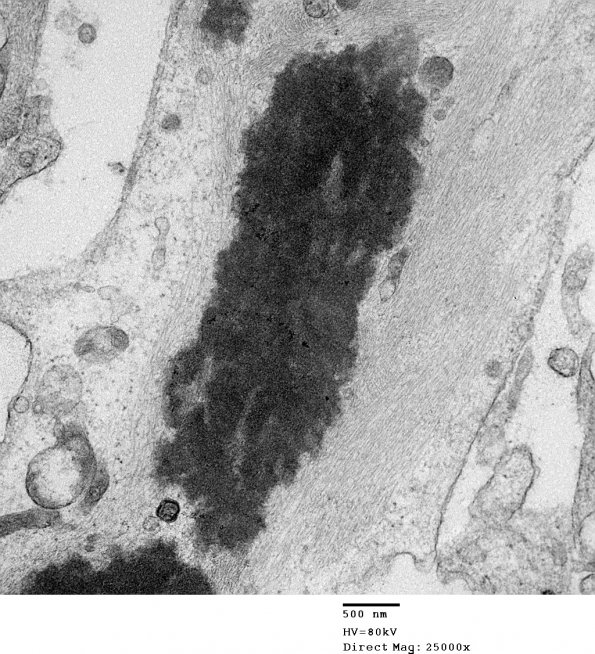 1C7 Astrocytoma, pilocytic (Case 1) 36 - Copy - Copy