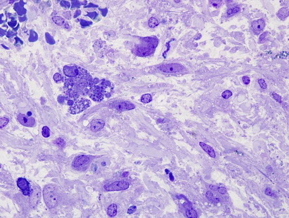 1D1 Astrocytoma, pilocytic (Case 1) Plastic 2