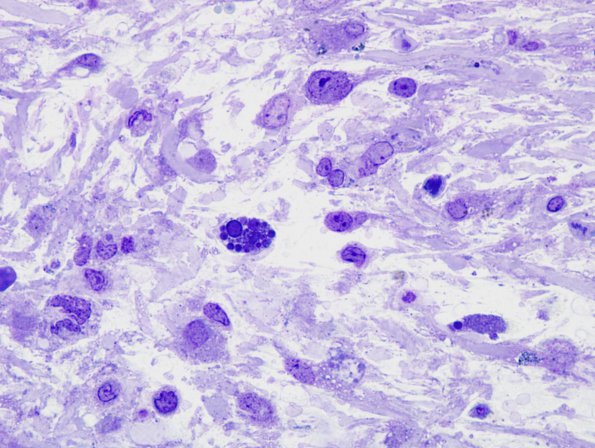 1D2 Astrocytoma, pilocytic (Case 1) Plastic 1