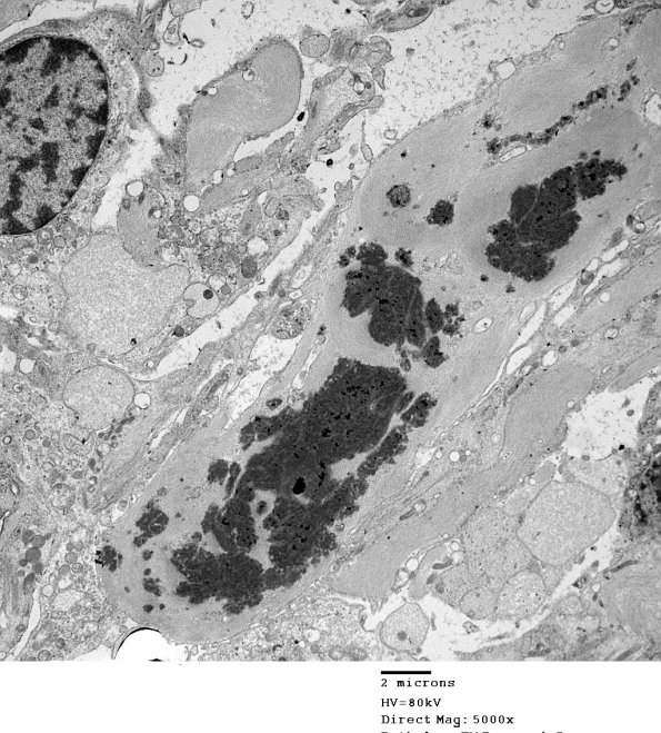 1D3 Astrocytoma, pilocytic (Case 1) 18 - Copy - Copy