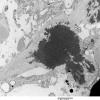 1D4 Astrocytoma, pilocytic (Case 1) 6 - Copy - Copy