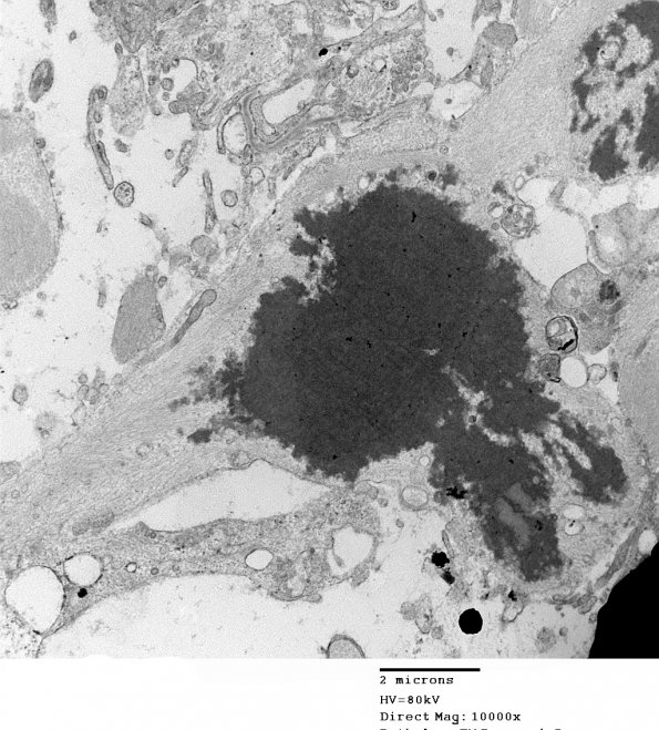 1D4 Astrocytoma, pilocytic (Case 1) 6 - Copy - Copy