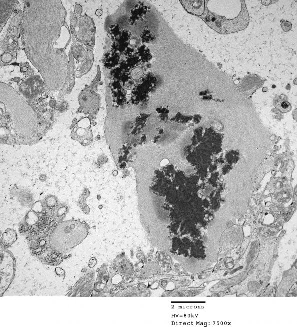 1D5 Astrocytoma, pilocytic (Case 1) 25A - Copy - Copy