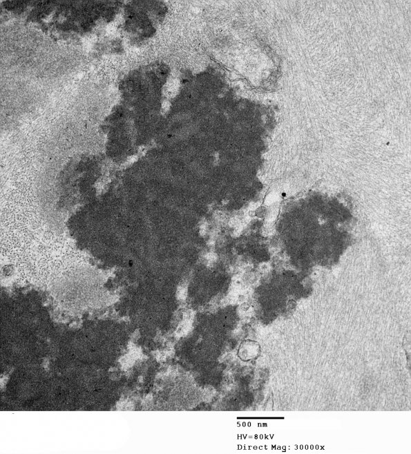 1D6 Astrocytoma, pilocytic (Case 1) 28 - Copy - Copy