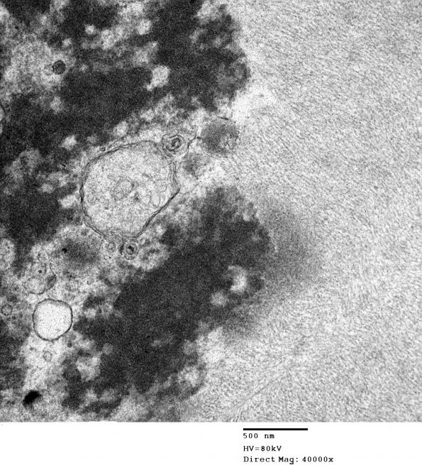 1D7 Astrocytoma, pilocytic (Case 1) 31 - Copy - Copy