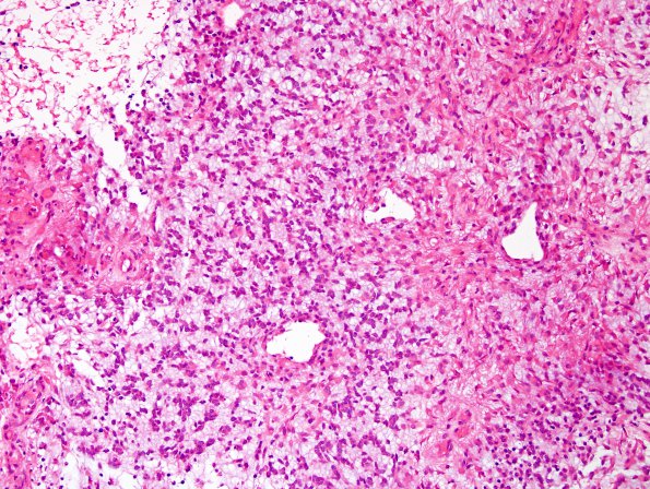 1A1 Astrocytoma, pilomyxoid (Case 1) H&E 1 (2).jpg