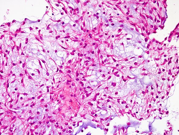 1A3 Astrocytoma, pilomyxoid (Case 1) H&E 10 a (7).jpg