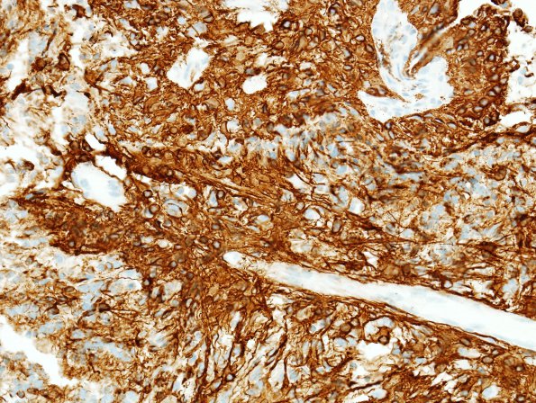 1B3 Astrocytoma, pilomyxoid (Case 1) GFAP 1