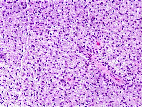 2B1 Astrocytoma, pilomyxoid (Case 2) c