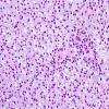 2B2 Astrocytoma, pilomyxoid (Case 2)-H&E-b