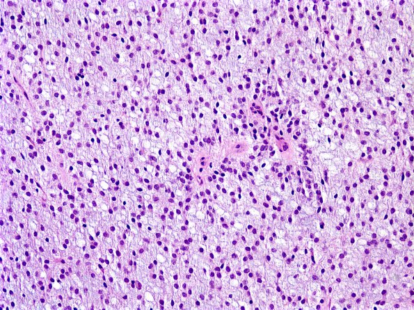 2B2 Astrocytoma, pilomyxoid (Case 2)-H&E-b