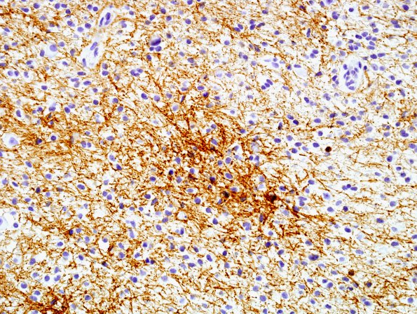 2C1 Astrocytoma, Pilomyxoid (Case 2) GFAP 1 (2).jpg