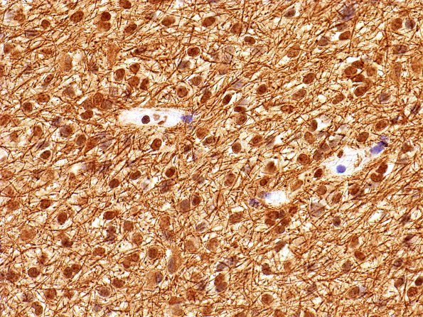 2C2 Astrocytoma, pilomyxoid (Case 2) GFAP 4