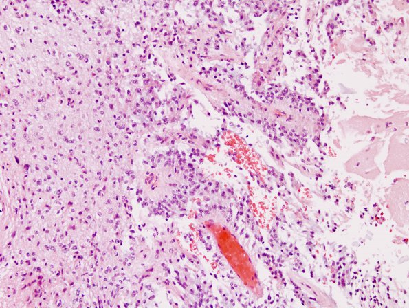 2D1 Astrocytoma, pilomyxoid (Case 2) H&E f