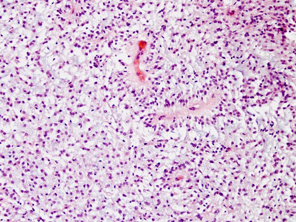 2D2 Astrocytoma, pilomyxoid (Case 2) H&E b