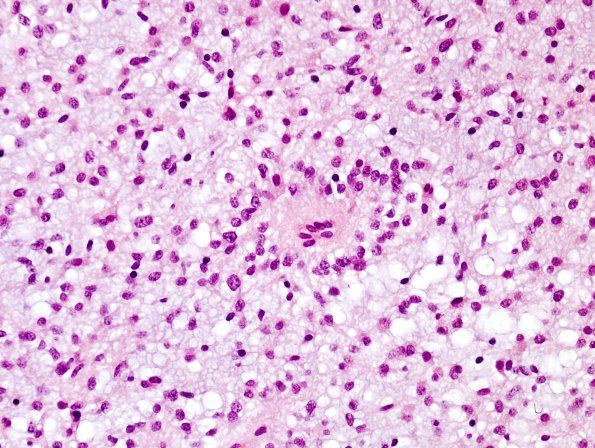 2D3 Astrocytoma, pilomyxoid (Case 2) H&E e