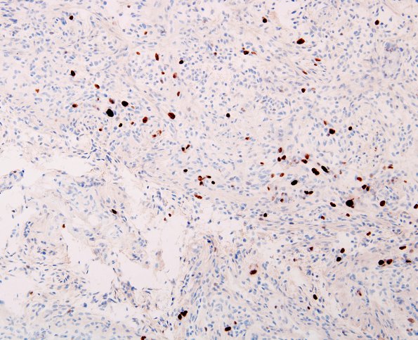 2F Astrocytoma, pilomyxoid (Case 2) MIB 1