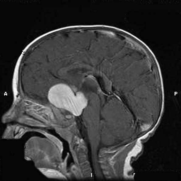 3A1 Astrocytoma, pilomyxoid (Case 3) MRIcGad20029