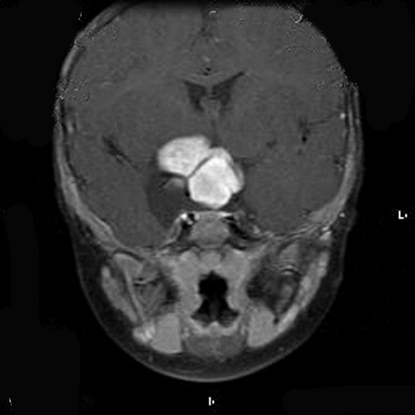 3A2 Astrocytoma, pilomyxoid (Case 3) MRIcGad-cor0012