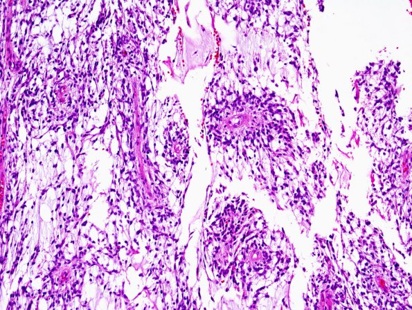 3B2 Astrocytoma, pilomyxoid (Case 3) 5.jpg