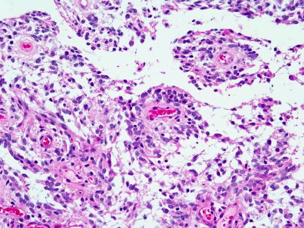 3B3 Astrocytoma, pilomyxoid (Case 3) 1.jpg