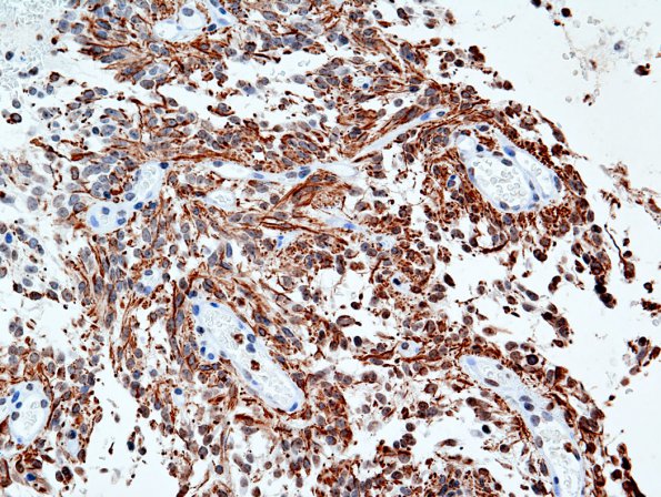 3C1 Astrocytoma, pilomyxoid (Case 3) GFAP 1.jpg