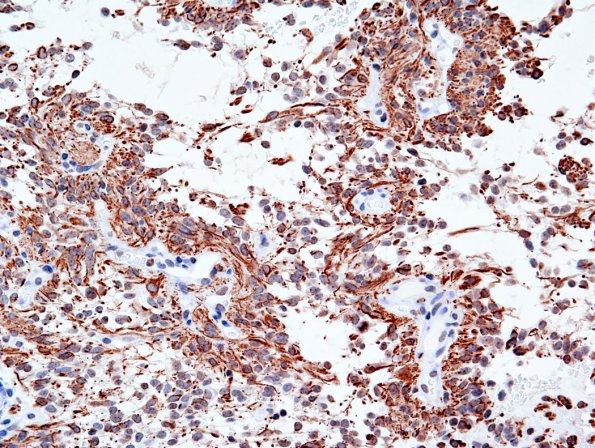 3C2 Astrocytoma, pilomyxoid (Case 3) GFAP 2.jpg